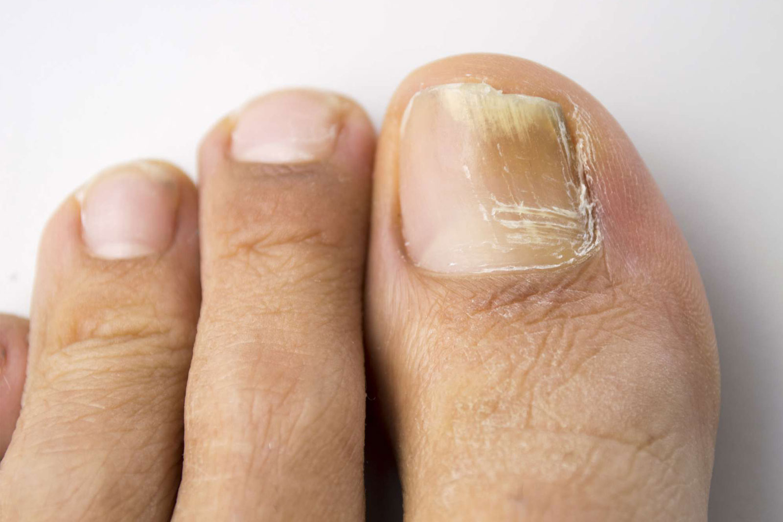 THE PODIATRY DIscoloured nails